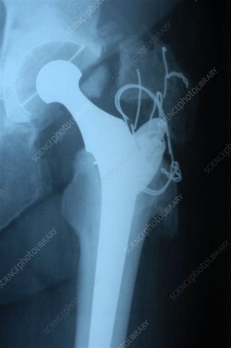 Total hip replacement, X-ray - Stock Image - M600/0296 - Science Photo ...