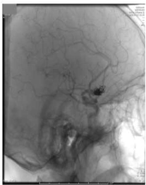 Figure 1 From MICROSURGICAL CLIPPING OF A PREVIOUSLY COILED ANTERIOR