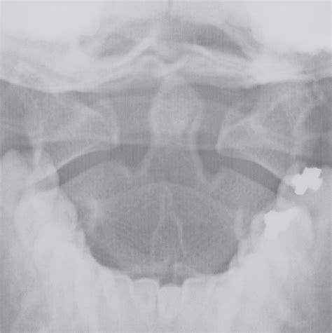 Male Cervical Spine Radiology Key