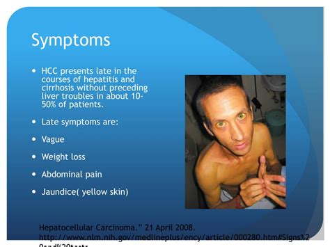 PPT - Hepatocellular carcinoma PowerPoint Presentation, free download ...