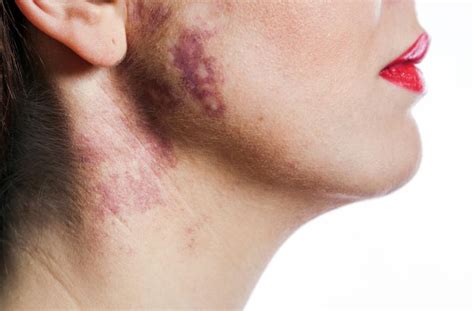 Port Wine Stain Birthmarks Lovetoknow Health And Wellness