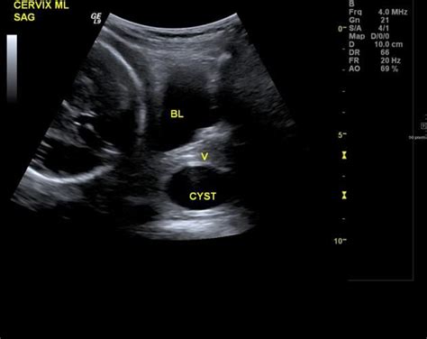 Gartner Duct Cyst Anatomy