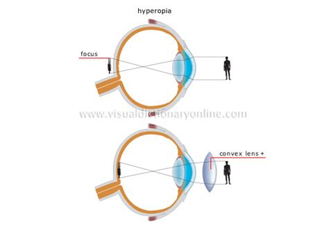 Science Physics Optics Vision Vision Defects 2 Image Visual Dictionary Online