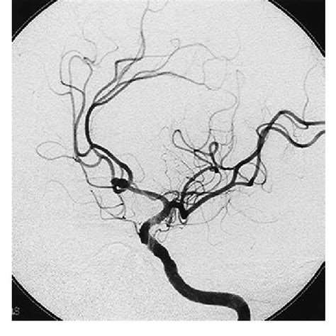 Preoperative Left Internal Carotid Angiogram Left Oblique Projection