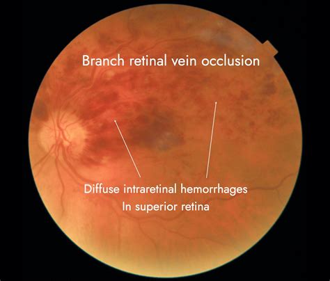 Retinal Vein Occlusion Blocked Vein Myeyespecialist