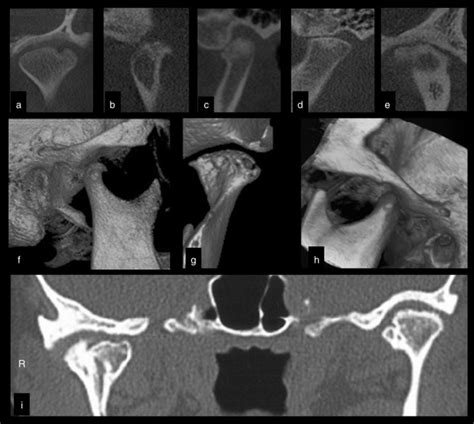 Cone Beam Computed Tomography CBCT Assessment Of Different TMJs In