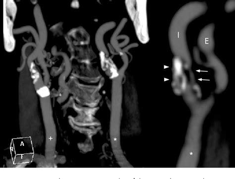 Figure 3 From Multidetector Computed Tomographic Angiography Of The