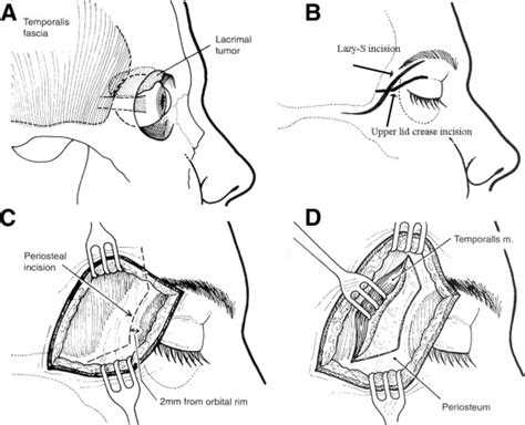 Surgical Management Of Lacrimal Gland Tumors Operative Techniques In