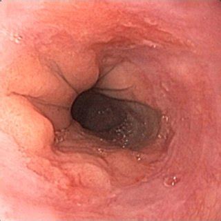 An Idiopathic Esophageal Ulcer Of The Distal Esophagus Prior To