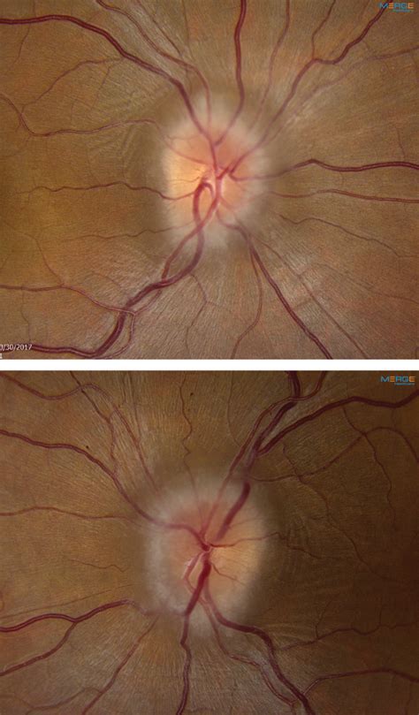 Papilledema Vs Glaucoma