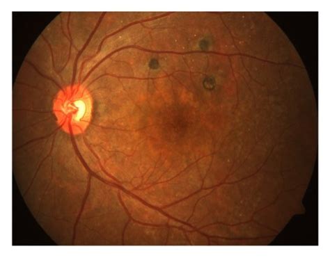 Fundus Photograph Prior To Cataract Surgery Right Eye A Showing