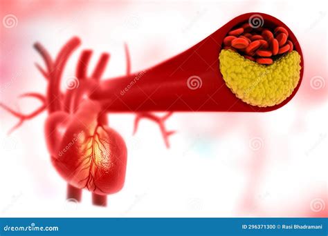 Clogged Arteries Stock Illustration Illustration Of Cardiovascular