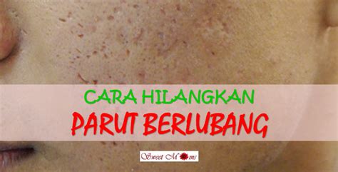 Cara Hilangkan Parut Jerawat Berlubang Dengan Mudah Dan Berkesan