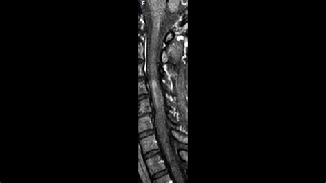 Spinal Cord Lesions - The Neurology Hub