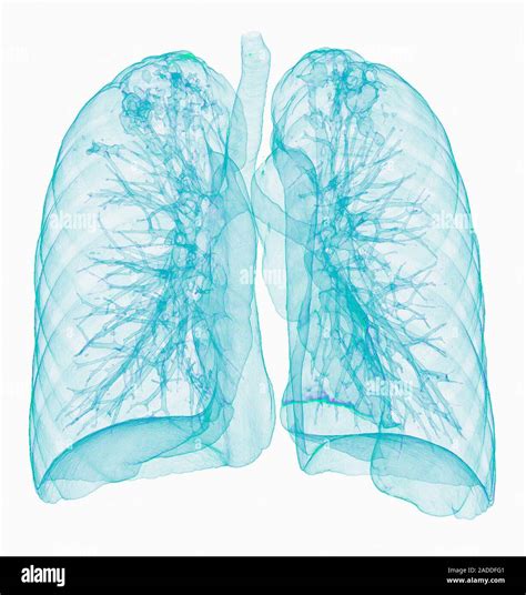 Pulmonary Tuberculosis Coloured Frontal 3D Computed Tomography CT