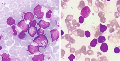 Peripheral Blood A And Bone Marrow B Analysis Showing Blasts In The