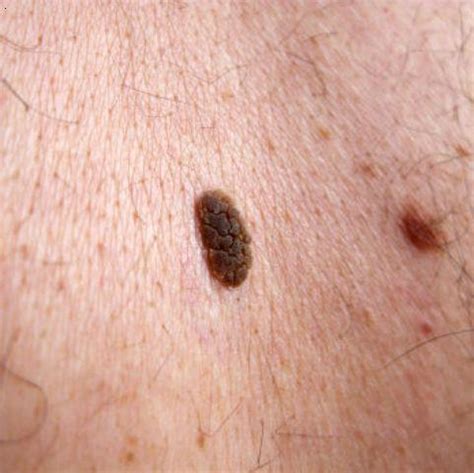 What causes moles? – What causes this?