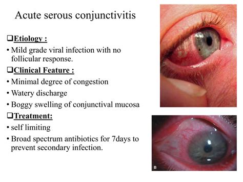 Viral Conjunctivitis Ppt Free Download