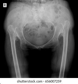 Photo De Stock Xray Pelvis Congenital Dislocation Hip 656007259