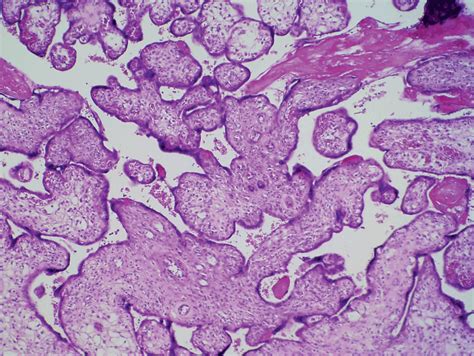 Chorionic Villi Histology