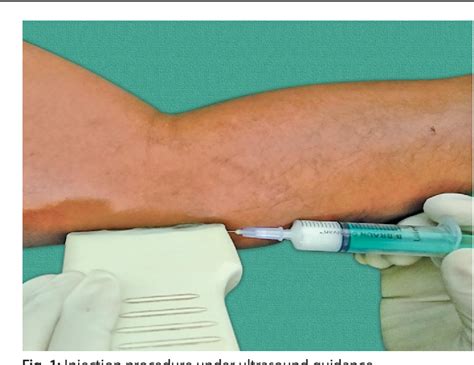 Figure From Efficacy Of Ultrasound Guided Autologous Blood Injection