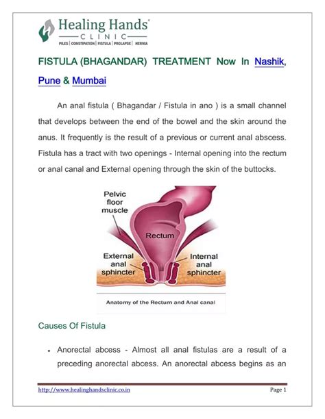 Ppt Fistula Treatment Now In Nashik Pune And Mumbai Powerpoint