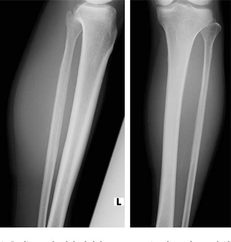 Figure 1 from A Traumatic Intermuscular Hematoma Mimicking a Soft-tissue Tumor: A Case Report ...