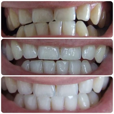 Crest 3D White Whitestrips до и после фото