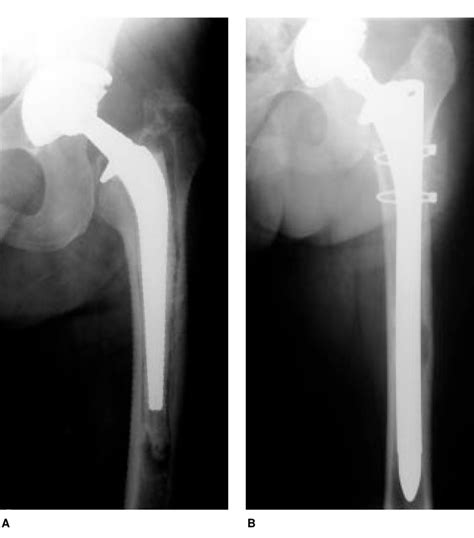 A Aseptic Loosening Of A Cemented Stem Note The Radiolucency At The Download Scientific