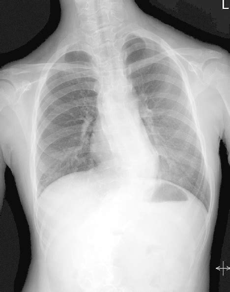 Chest X Ray Shows Thoracolumbar Scoliosis Download Scientific Diagram