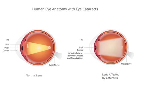 Understanding Cataracts Causes Symptoms Treatment