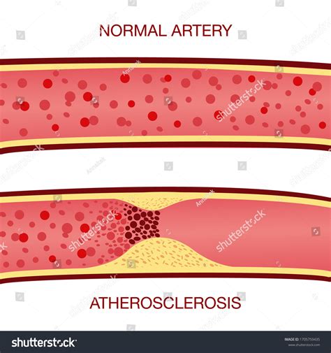 Vektor Stok Healthy Atherosclerosis Vessels Blood Cells Vector Tanpa