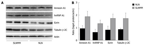 Up Regulation Of Hnrnp A1 Ezrin Tubulin β 2c And Annexin A1 In Sentinel Lymph Nodes Of