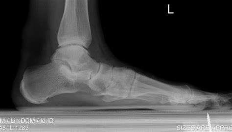 Aquired Adult Flatfoot Deformity The Bone School