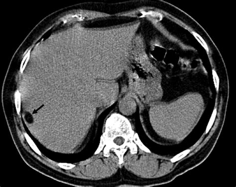 Fat Containing Lesions Of The Liver Cross Sectional Imaging Findings