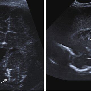 Newborn with holoprosencephaly. Coronal ultrasound image obtained with ...