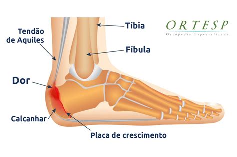 Dor No Calcanhar Voc Conhece A Doen A De Sever
