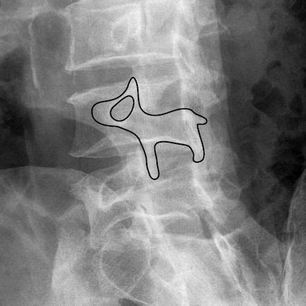 Scotty dog | Radiology Case | Radiopaedia.org | Radiology, Radiology student, Radiology imaging