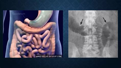 Paralytic ileus | PPT