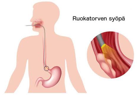 Tutustu Imagen Ruoka Juuttuu Kurkkuun Abzlocal Fi