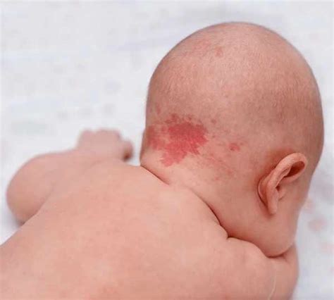 Strawberry Birthmark Spiritual Meaning Love And Connection