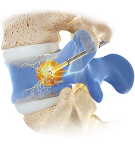 Intracept Procedure - Rockville, MD & Frederick, MD: Pain Management ...