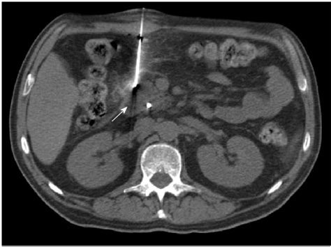 Percutaneous Computed Tomography Guided Core Needle Biopsy Of A Download Scientific Diagram