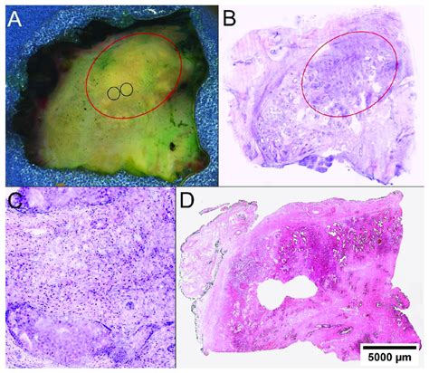 Locating Pca In Prostatectomy Specimens A On The Macroscopic Image