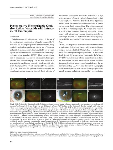 PDF Postoperative Hemorrhagic Occlusive Retinal Vasculitis With