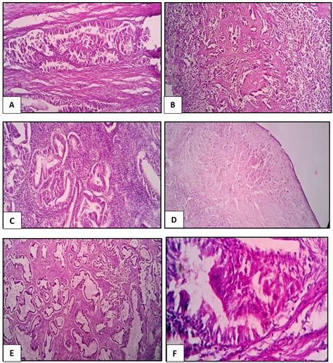 Ab Shows An Infiltrating Tumor Mainly Arranged In Glands Lined By