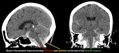 CT Case 004 LITFL CT Scan Interpretation