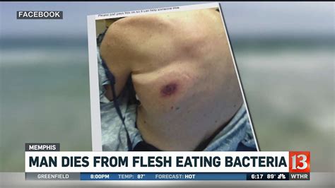 Man Dies From Flesh Eating Bacteria Youtube