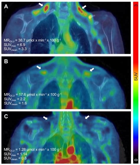 Ijms Free Full Text Metabolically Active Brown Adipose Tissue Is