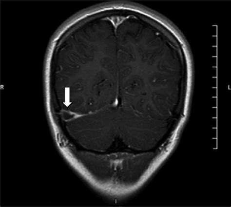 T1 Weighted Mri Showing A Thrombus In The Right Transverse Sinus Arrow